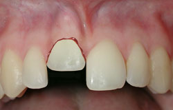 Image result for Dental Intrusion