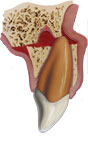 alveolar-fracture4