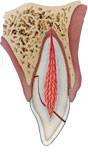 Luxation injury: Extrusion - Dental Trauma Guide