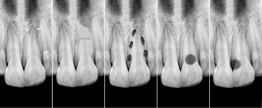 external resorption of tooth