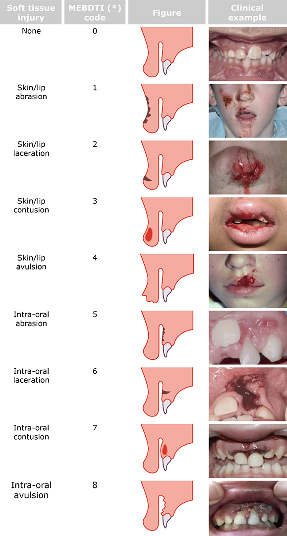 Categorization of Dental Fractures